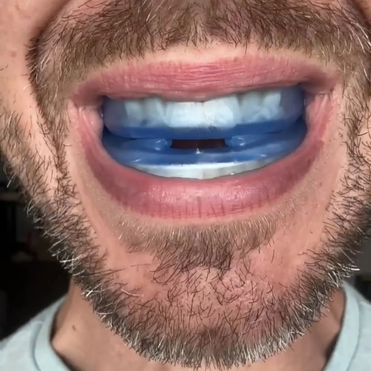 Snorva – Medical-Grade Anti-Snoring Mouthpiece | Discreet & Comfortable